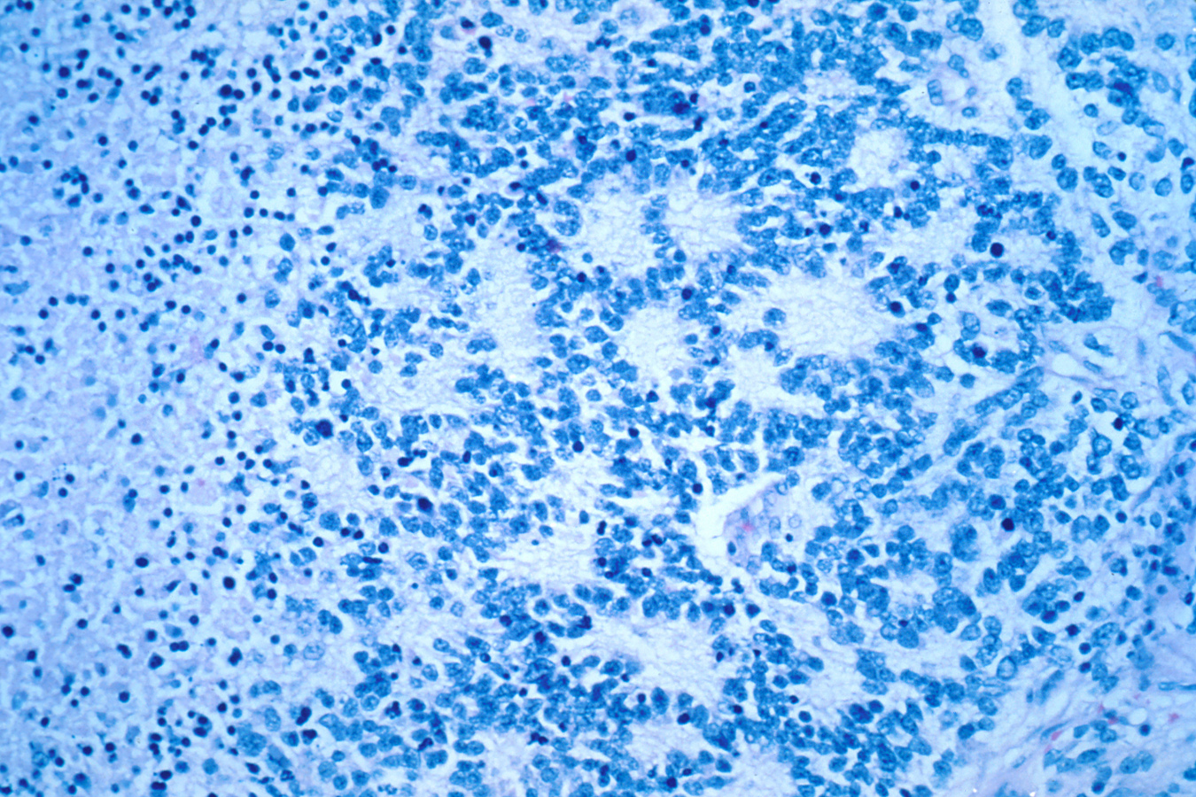 Neuroblastoma_rosettes