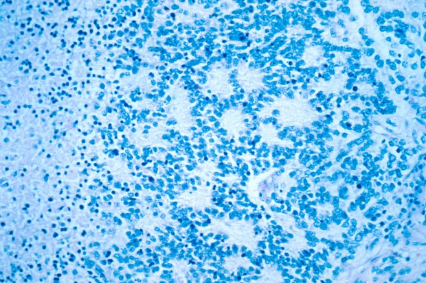 Neuroblastoma_rosettes